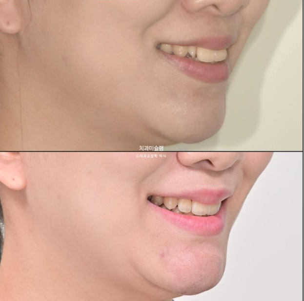 30대 인비절라인 덧니 발치교정 개방교합 치료 관련 이미지 25