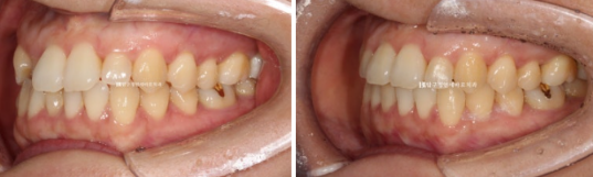 토끼이빨 치아교정 ? 토끼이빨 교정 치료기간은 어떻게 되나요? 관련 이미지 9