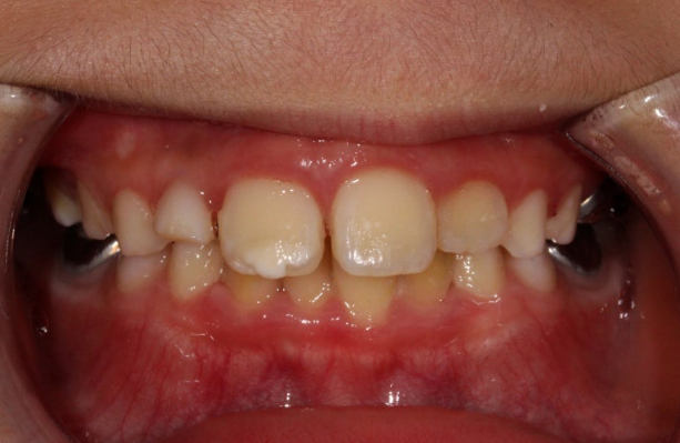 치아 흰색 얼룩 ? 갈아내지 않고 치료하는 법 관련 이미지 4