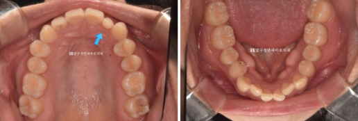 앞니 부분교정은 어떤 경우에 가능한가요? 단기 앞니 부분교정 왜소치 치료 무삭제 라미네이트 관련 이미지 3