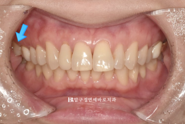 40대 인비절라인 라이트 가위교합? 관련 이미지 3