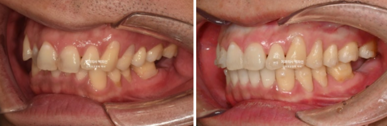 40대 인비절라인 라이트 과개교합 과잉치 덧니 교정 임플란트 보철 교정 후기 관련 이미지 13