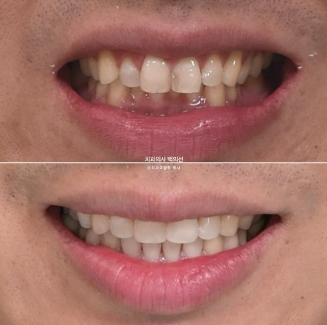 40대 인비절라인 라이트 과개교합 과잉치 덧니 교정 임플란트 보철 교정 후기 관련 이미지 23