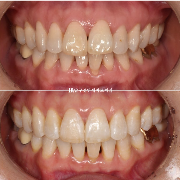 50대 치아교정 인비절라인 라이트 앞니교정 치료 후기 관련 이미지 13