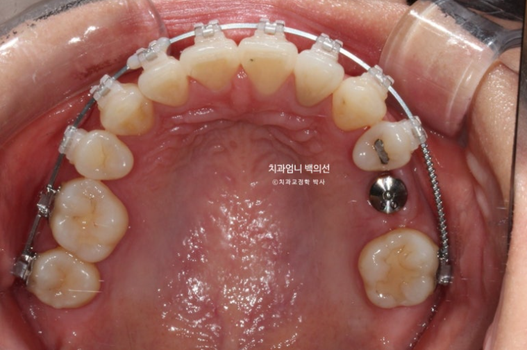 옥니 교정 역교정 재교정 무턱교정 치료기간 1년 10개월 관련 이미지 11