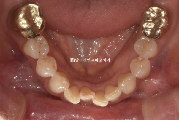 50대 인비절라인 라이트 교정 사례|왜소치·과개교합 개선 후 무삭제 라미네이트까지 관련 이미지 5