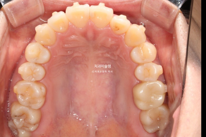 인비절라인 라이트 반대교합? 덧니 중심선 치간삭제 치료 관련 이미지 9