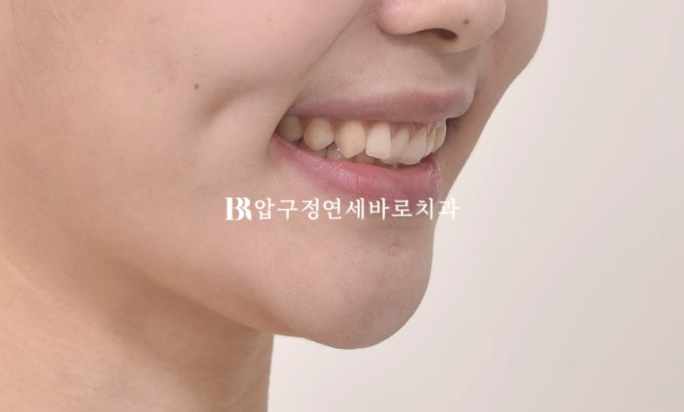 옥니 교정 인비절라인 라이트 옹니 덧니 치료기간 ? 관련 이미지 5