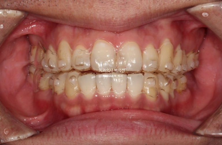 40대 인비절라인 라이트 과개교합 과잉치 덧니 교정 임플란트 보철 교정 후기 관련 이미지 9