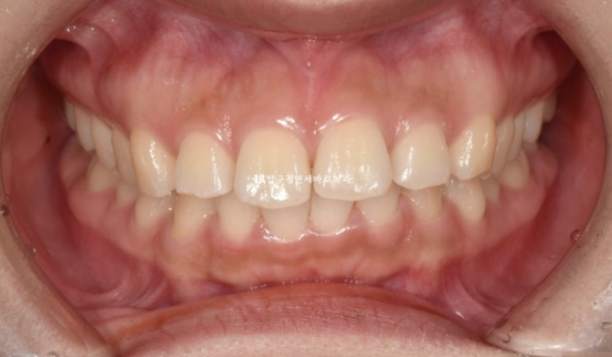 돌출입 교정 치아 벌어짐 인비절라인 투명교정 치료 관련 이미지 2