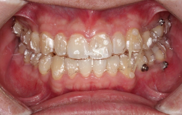 비대칭 비발치 거미스마일 잇몸미소 중심선 가위교합치료 무삭제 라미네이트 관련 이미지 9