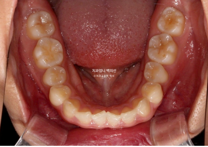 과개교합 옥니 거미스마일 교정 인비절라인 라이트 잇몸성형 후기 관련 이미지 5