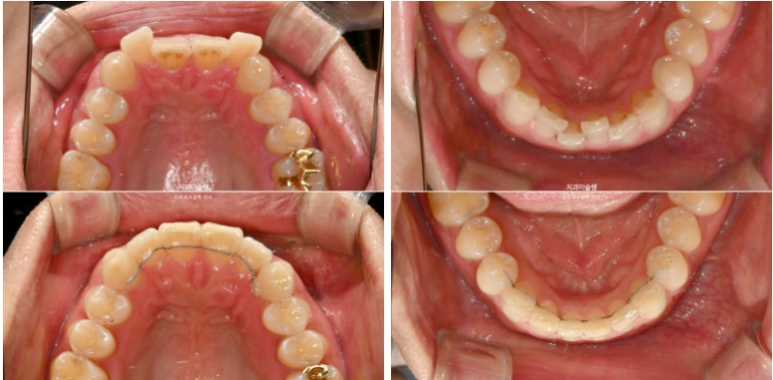 덧니 앞니 부분교정 급속교정 단기 MTA 미니튜브 기간 6개월 관련 이미지 13