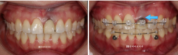 임플란트 없이 자연치아 살리기 앞니 부분교정 보철교정 관련 이미지 2