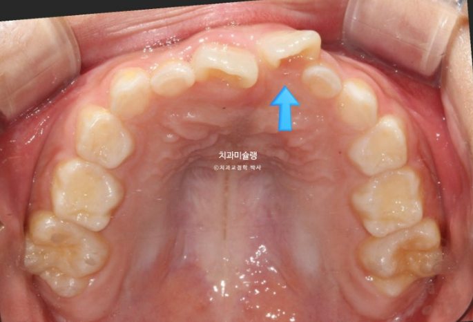 7세 어린이 반대교합 부정교합 프리올소 치료 관련 이미지 4