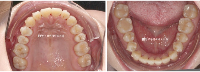 Is compliance important for Invisalign? | A real case that improved reverse bite and scissors bite in 8 months image 7
