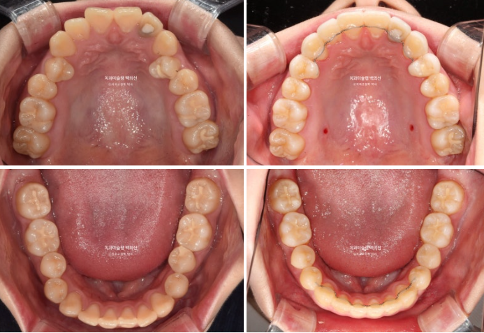 잇몸미소 인비절라인 거미스마일 토끼이빨 교정 무삭제 라미네이트 반대교합 치료 후기 관련 이미지 17
