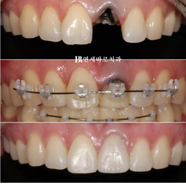 임플란트 없이 자연치아 살리기 앞니 부분교정 보철교정 관련 이미지 8