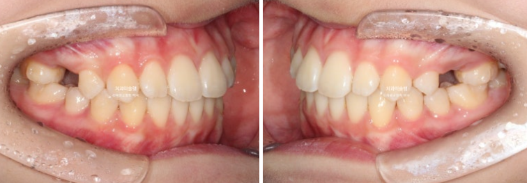 돌출입 비발치 어린이 교정 입술부전증 호두주름 호두턱 토끼이빨 인비절라인퍼스트 관련 이미지 13