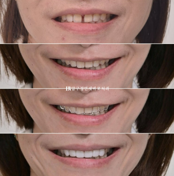 벌어진 앞니, 바로 라미네이트 하지 않은 이유｜인비절라인 후 무삭제 라미네이트 실제 사례 관련 이미지 26