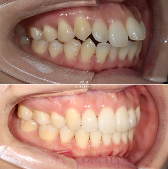 30대 돌출입 덧니 교정 인비절라인 발치교정 후기 관련 이미지 18