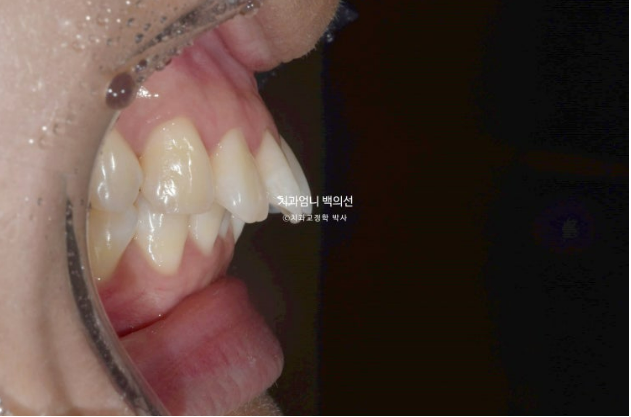 인비절라인으로 발치교정이 가능할까요? 돌출입&middot;과개교합 발치교정 증례 관련 이미지 4