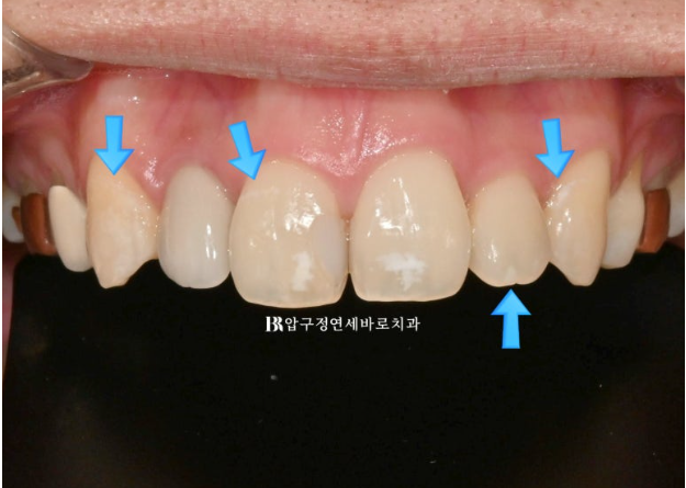 Icon White Spots on Teeth: Resin Treatment for White Spot Lesions image 4