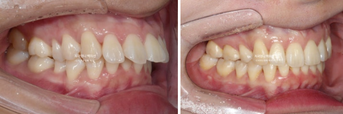 돌출입 교정 인비절라인 발치 교정 후기 관련 이미지 14