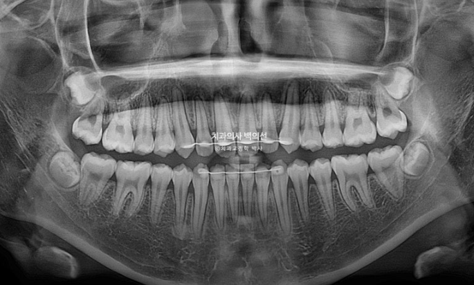 중학생 주걱턱 반대교합 개방교합 덧니 교정 인비절라인 후기 관련 이미지 16