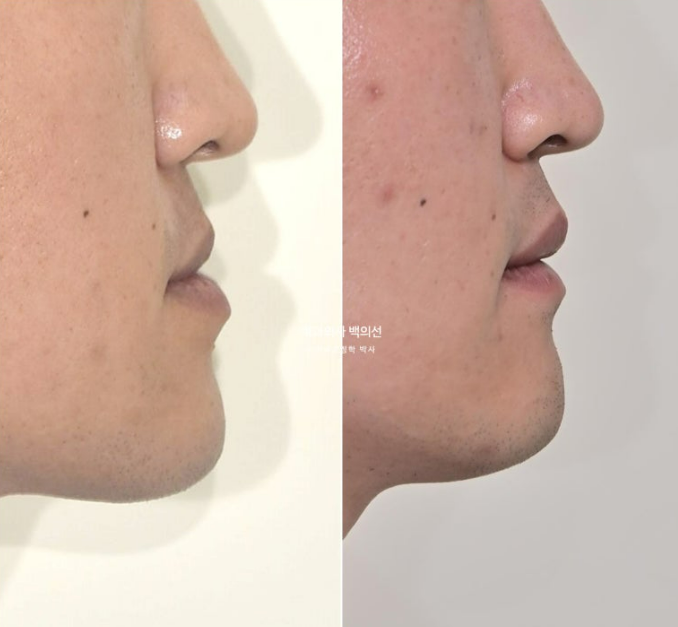 30대 주걱턱 비수술 비발치 교정 후기 관련 이미지 15
