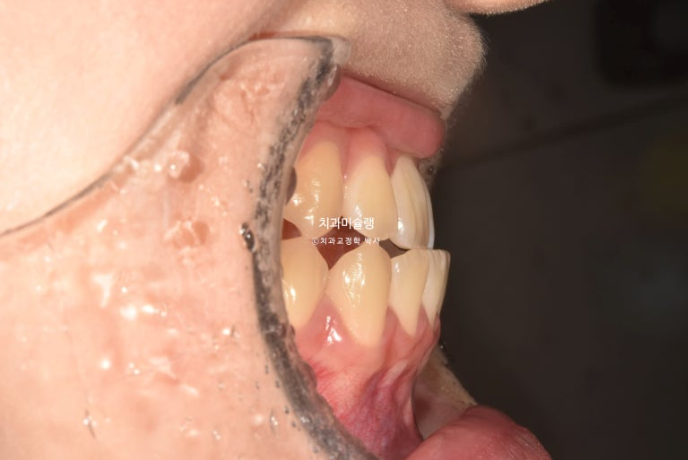비발치 비수술 주걱턱 반대교합 재교정 치료 관련 이미지 4