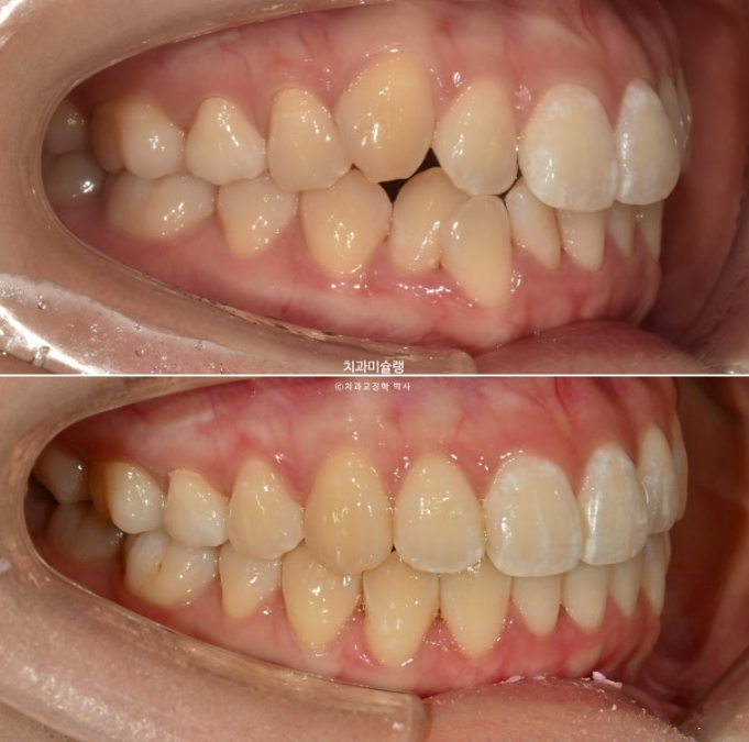 인비절라인 비발치 토끼이빨 교정 덧니 교정 치료기간 1년 8개월 관련 이미지 14