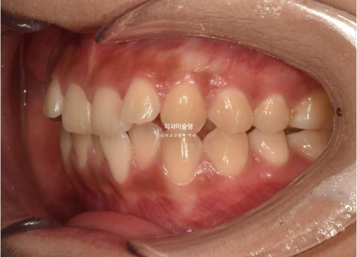 유학생 치아교정 해외거주 한국에서 치아교정? 관련 이미지 4