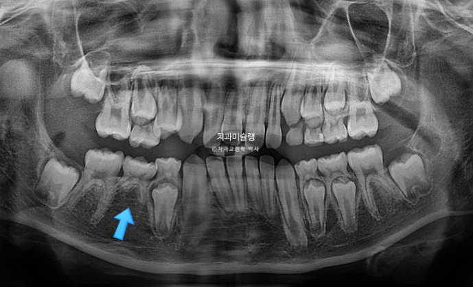 선천적 결손 잔존유치 과개교합 돌출입 인비절라인 퍼스트 어린이 투명교정 치료기간 관련 이미지 6