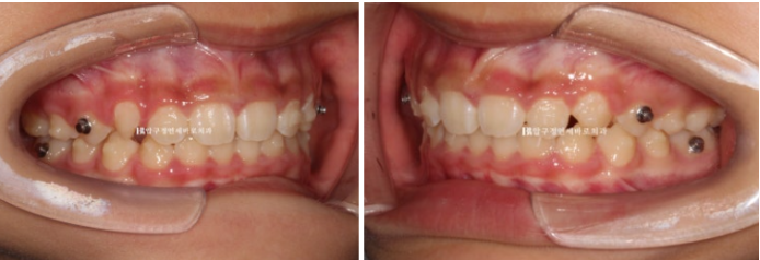 Pediatric Clear Aligners That Improved Both Deep Bite and Protruding Teeth image 11