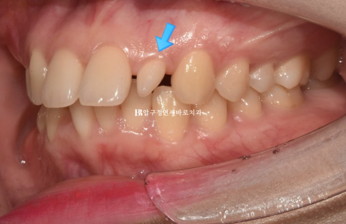 Actual Case of Treating Congenitally Missing and Peg-Shaped Teeth Without Implants image 3