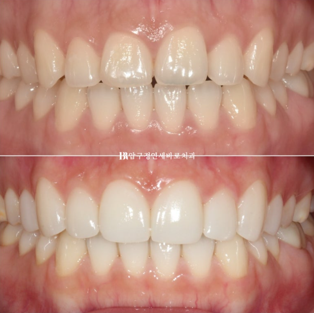 Before and After Non-Prep Veneers: Improving Gaps Between the Front Teeth and the Smile Line Together image 15