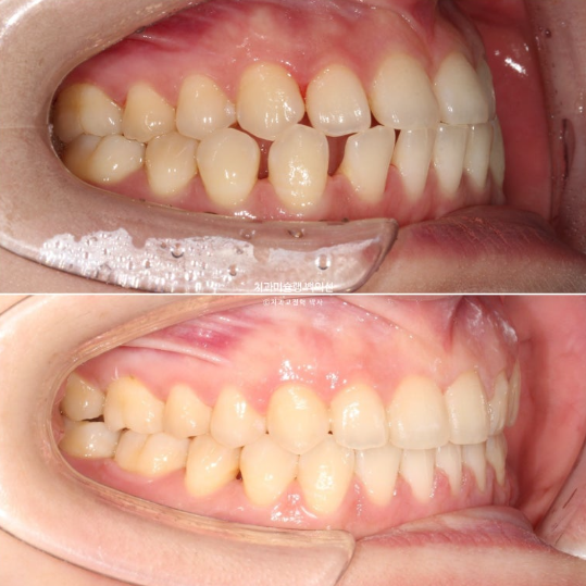 앞니 벌어짐 합죽이 방지 교정 기간 1년 4개월 관련 이미지 14