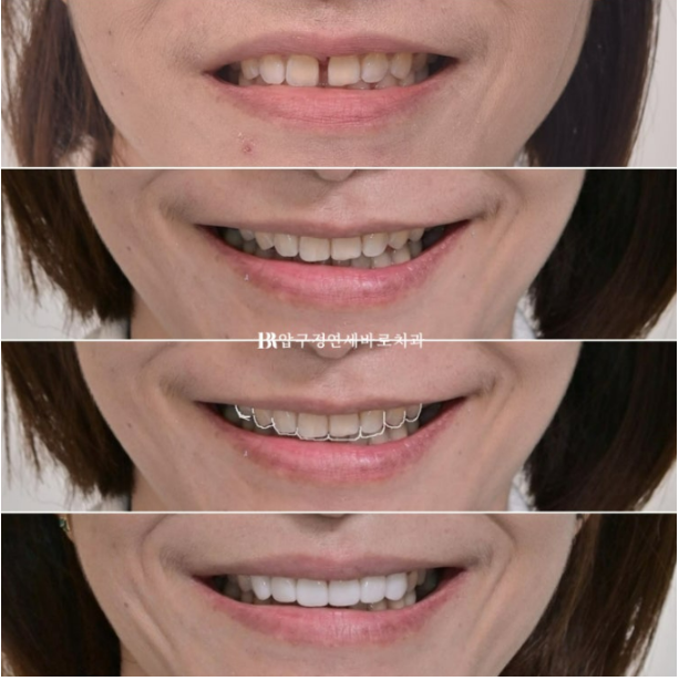 Can Gaps Between the Front Teeth Be Treated with No-Prep Veneers Alone? A Real Case Completed with Gelami After Invisalign Lite image 26