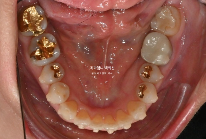 50대 캔팅 교합평면 기울어짐 덧니 교정 인비절라인 라이트 교정? 관련 이미지 7