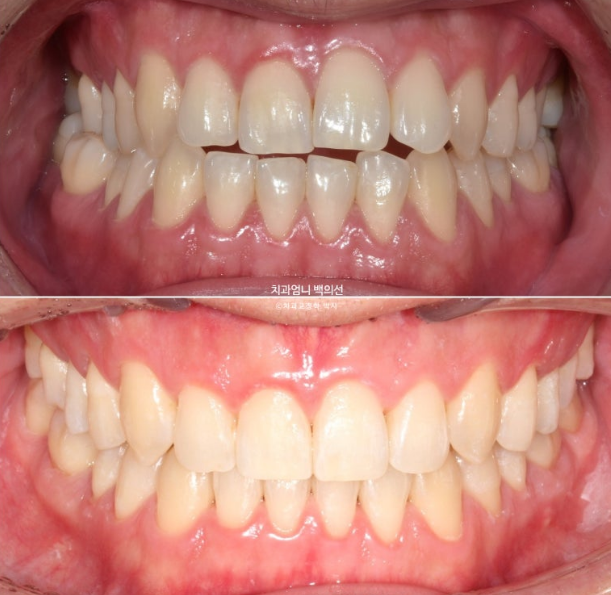 MSE Palatal Expansion Invisalign Underbite Correction, Non-Surgical image 1