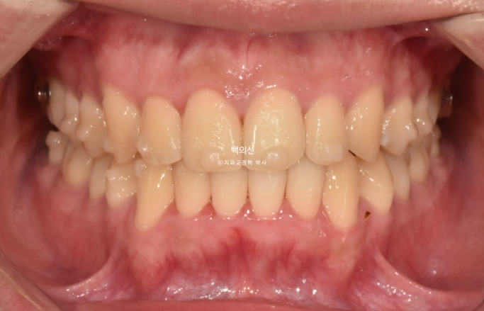 유학생 교정 인비절라인 라이트 치료기간 5개월 관련 이미지 6
