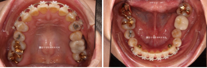 Orthodontics in Your 40s: Worried Your Gums Will Recede? | A 6-Month Front Teeth Partial Orthodontic Case That Also Improved Black Triangles image 6
