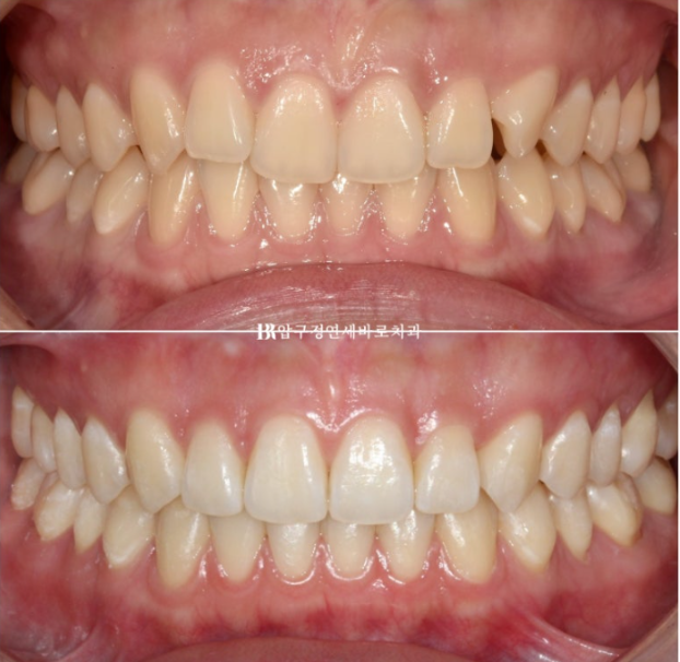 If Inward-Tilted Teeth Make Your Smile Look Constricted? Invisalign Before and After image 15