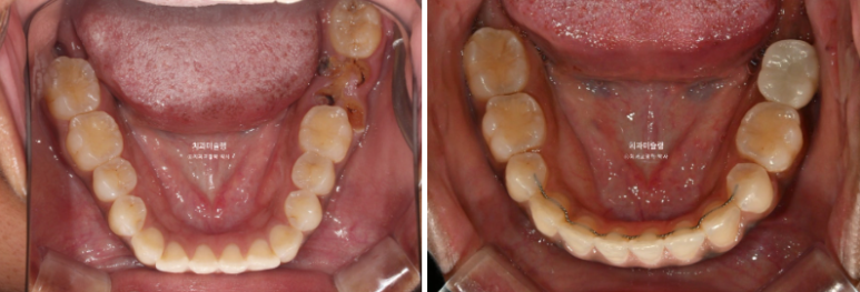 Extraction & re-orthodontics with Clippy-C, intrusion for dental implant. 관련 이미지 18