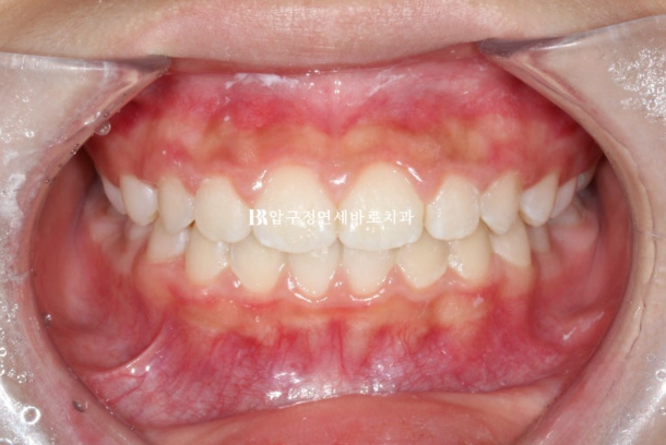 A Child’s Protruding Teeth Correction Review: Difficulty Closing the Lips image 11