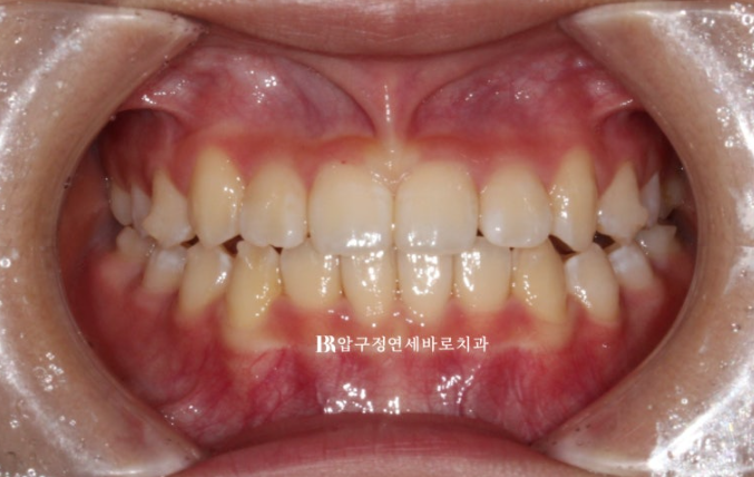 Simultaneous Arch Expansion and Teeth Alignment for Elementary School Children with Invisalign｜Invisalign First image 8