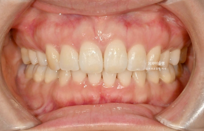 돌출입 덧니 발치 교정 인비절라인 교정 후기 관련 이미지 20