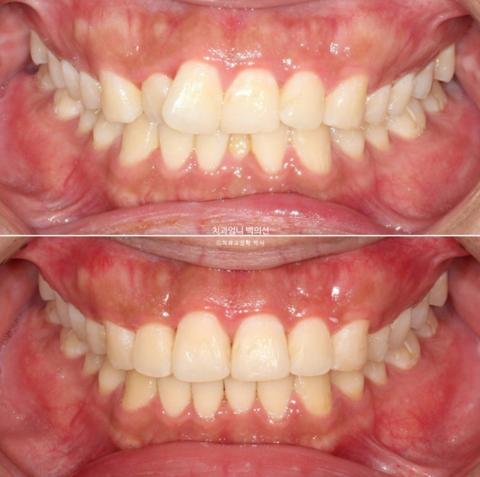 앞니 부분교정 덧니 교정 블랙트라이앵글 부정교합 마모 시뮬레이션 치료기간 5개월 관련 이미지 1