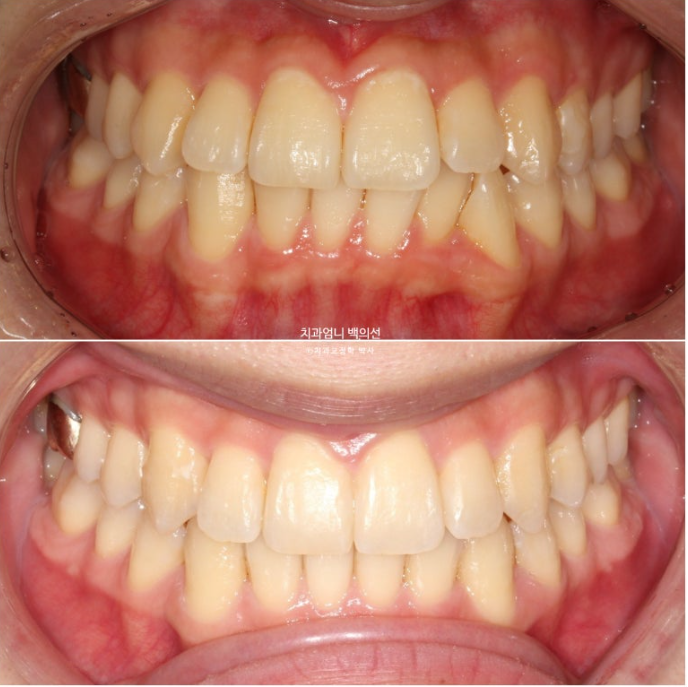 인비절라인 비발치 앞니 돌출 덧니 교정 ? 관련 이미지 14